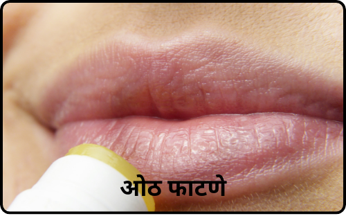 oth fatne oth ulnae mhnje kay chapped lips chapped lips in marathi gharguti ramban upcahr for chapped lips in marathi treatment of crack lips in marahti gharguti upchar for crack lips