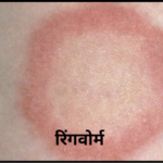 रिंगवोर्म ringworm w