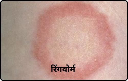 रिंगवोर्म ringworm w