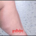 हत्तीरोग हत्तीरोग आजार एलिफंटायसिस filariasis what is filariasis filariasis kashala mhnatat