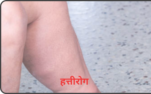 हत्तीरोग हत्तीरोग आजार एलिफंटायसिस filariasis what is filariasis filariasis kashala mhnatat